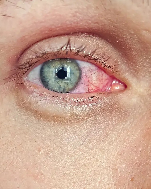 Tratamento de Glaucoma